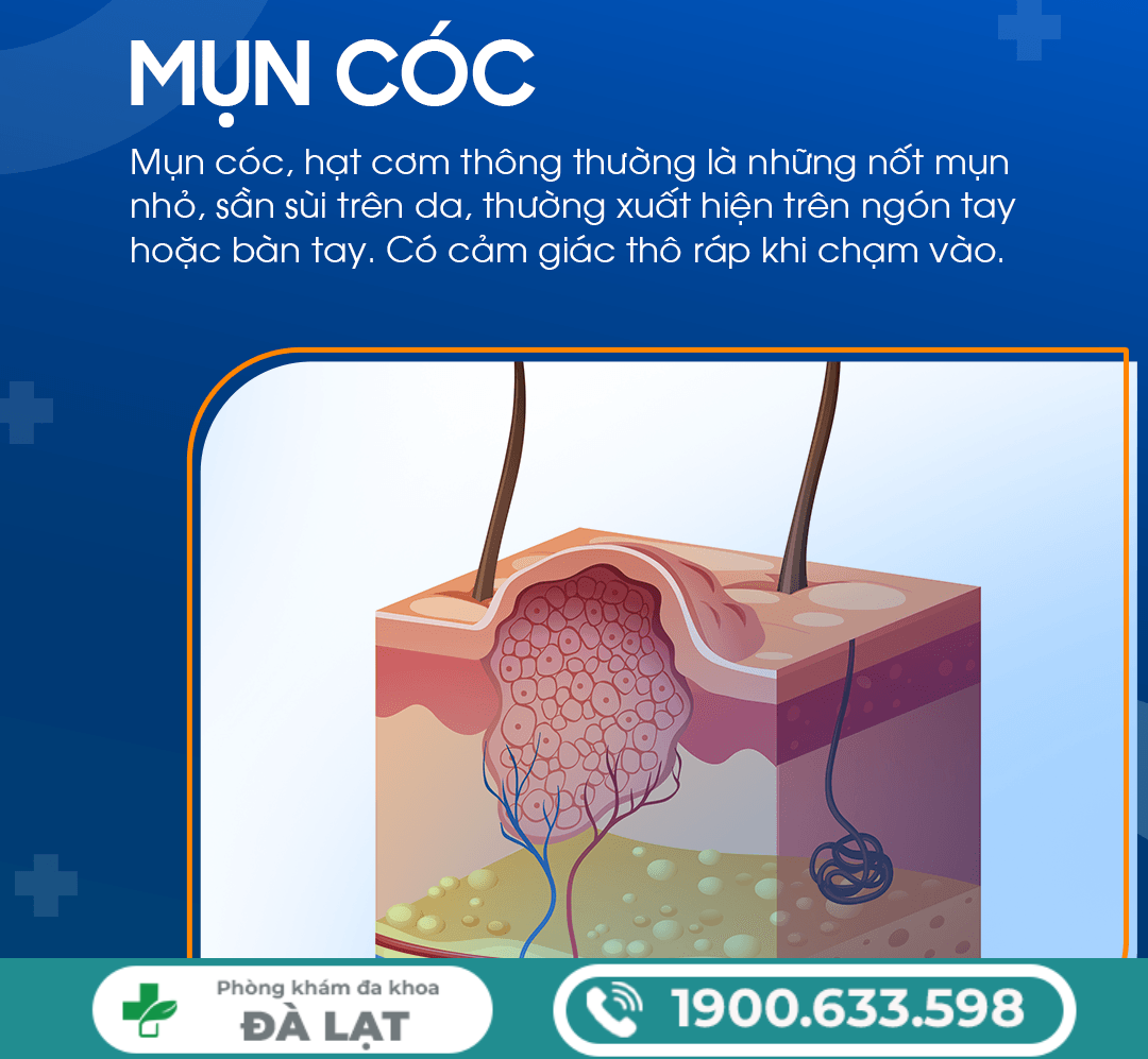 Hình ảnh minh họa